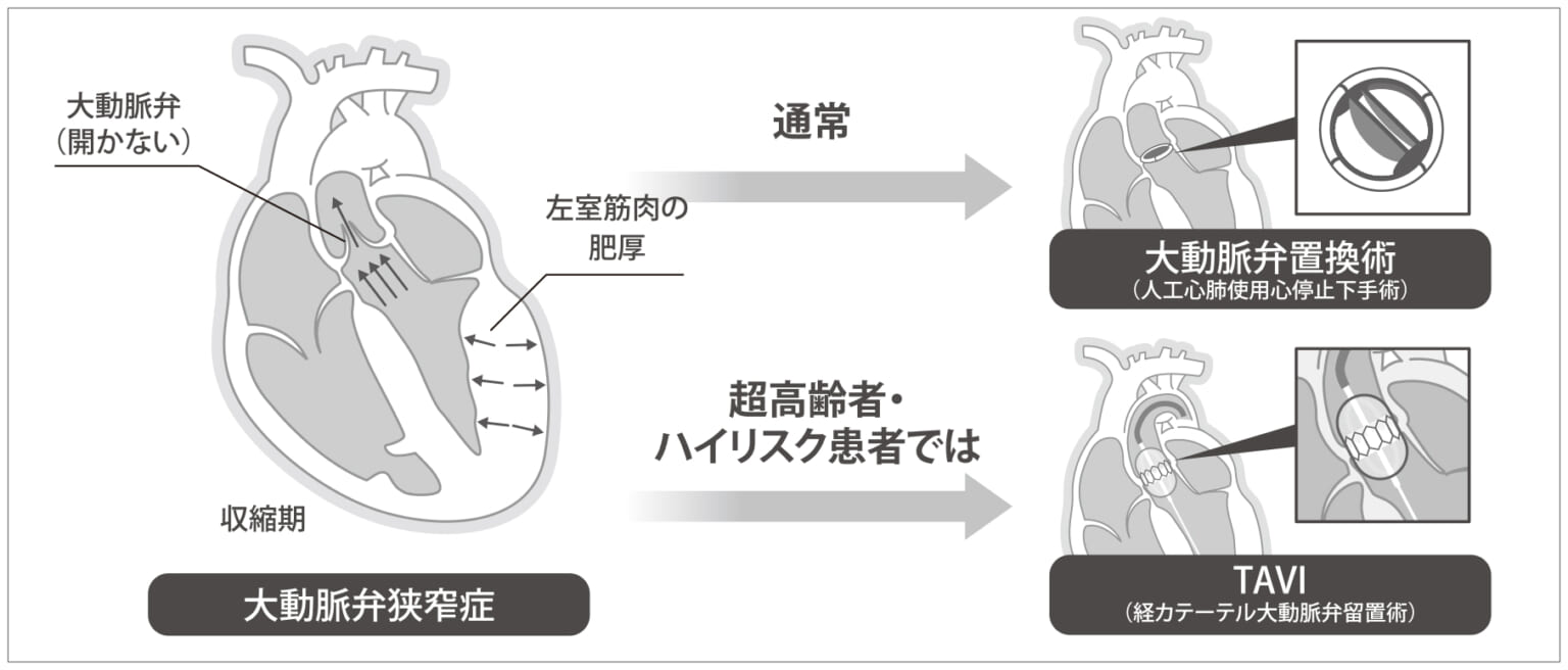 TAVI を受ける準備ができているかどうかを確認するために医師の診察を受ける女性